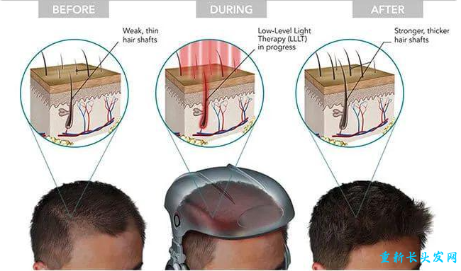 激光治疗脱发原理