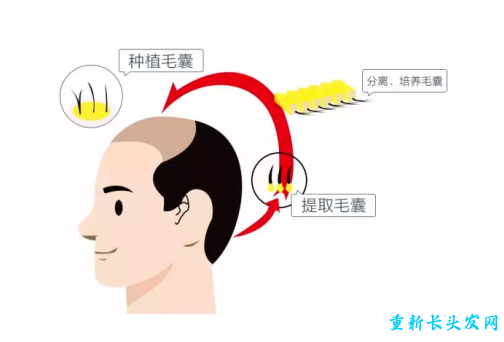 植发原理