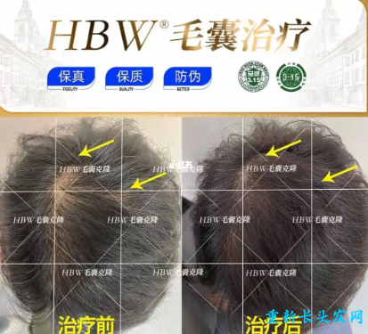 hbw毛囊克隆植发