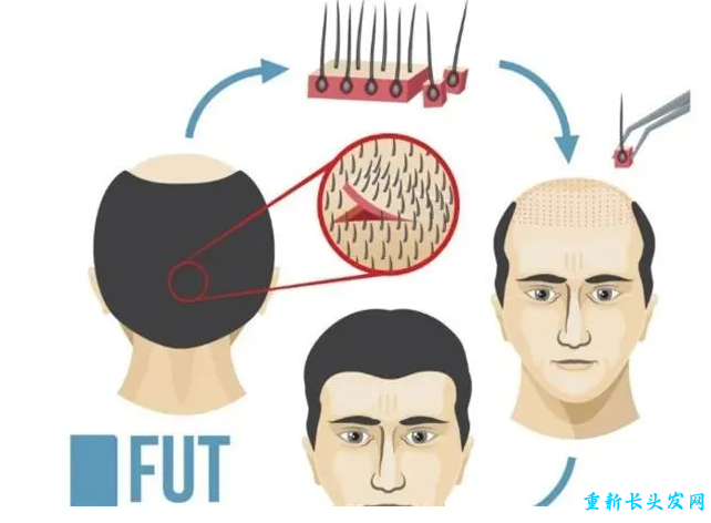 FUT植发技术